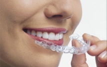 Phương pháp chỉnh hình răng mới Invisalign teen 