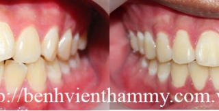 Niềng răng chen chúc với mắc cài kim loại