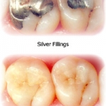 BỀN VỮNG HAY THẨM MỸ SỰ TRANH CÃI LỚN TRONG NHA KHOA PHỤC HỒI