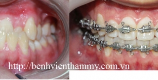 Chỉnh hình răng thẩm mỹ điều trị răng móm 1