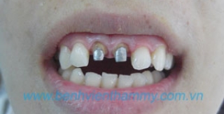 Răng toàn sứ Emax ZirCad