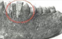 Lịch sử về cấy ghép răng (implant) 