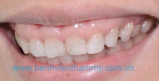 Răng sứ Emax Zircad - Ivoclar Vivadent 5