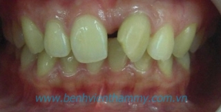 Răng sứ Ivoclar vivadent 14