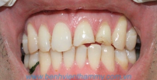 Răng sứ Emax Zircad - Ivoclar Vivadent 2