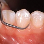 Các cách chữa trị răng sâu