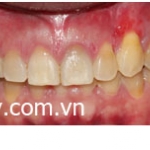 Chỉnh hình răng thẩm mỹ điều trị răng thưa do răng nanh mọc ngầm với mắc cài kim loại