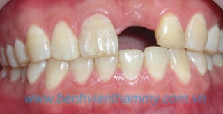 Implant môt răng trước
