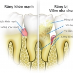 Điều trị nha chu, viêm nướu êm ái với Airflow Thụy Sĩ