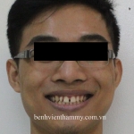 Cải thiện nụ cười với niềng răng.........! 02