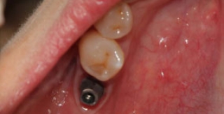 Cấy ghép implant 3