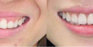 Chỉnh hình răng thẩm mỹ điều trị cười hở nướu và hàm lệch với mắc cài kim loại