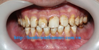 Răng sứ Emax Zircad - Ivoclar Vivadent 11