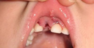 Xử trí khi răng trẻ bị bật khỏi ổ răng