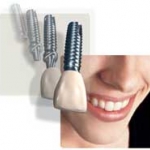 Cấy Ghép Răng Có Răng Giả Trễ 