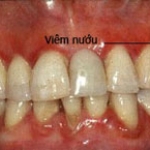 Viêm nướu răng ở trẻ em