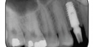 Cấy ghép Implant là gì ?