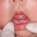 Gồng mình - nghiến răng trẻ có thể bị thiếu canxi ?