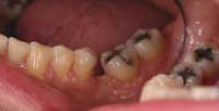 Mất răng, tăng nguy cơ ung thư