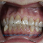 Răng sứ Emax Zircad - Ivoclar Vivadent 6