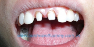 Răng sứ Emax Zircad - Ivoclar Vivadent 3