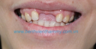 Răng sứ Cercon Smart