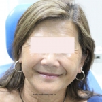 Implant toàn hàm