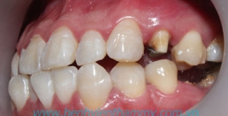 Răng sứ Ivoclar vivadent 13