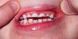 Tật nghiến răng ở trẻ em – Phần 1 