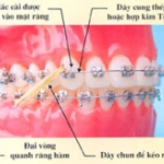 Phụ huynh và trẻ -Sự cần thiết trong điều trị chỉnh nha thành công