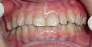 Răng sứ Cercon Smart - Denstfly 3