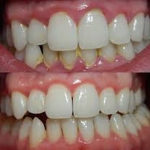 Dị ứng và viêm nướu
