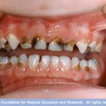 CHẾ ĐỘ ĂN VÀ SÂU RĂNG