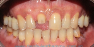 Răng sứ Ivoclar vivadent 11