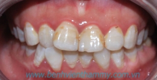 Răng sứ Ivoclar vivadent 12