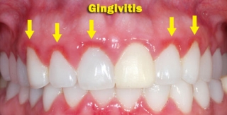 Viêm nướu do vệ sinh răng miệng chưa tốt