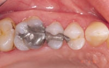 Hợp chất trám răng chứa thủy ngân an toàn cho sức khỏe