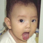 Ung thư lưỡi liên quan đến bệnh răng lợi mạn tính 