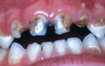 Trẻ Em Bị Sâu Răng Tăng Cao Nguy Cơ Mập Phì