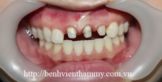 Răng sứ Ivoclar vivadent 16