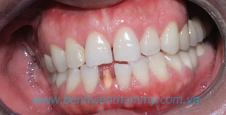 Răng sứ Ivoclar vivadent 10