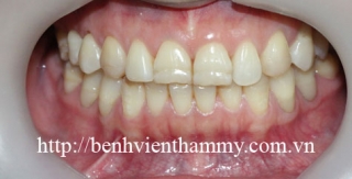 Răng sứ Emax Zircad - Ivoclar vivadent 13