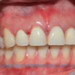 Răng sứ thẩm mỹ 4 răng Emax ZirCad