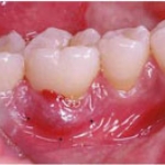 CÁCH ĐIỀU TRỊ BỆNH NHA CHU
