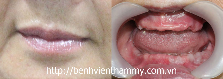 cay ghep rang implant 06