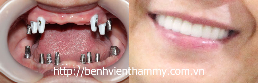 cay ghep rang implant 07