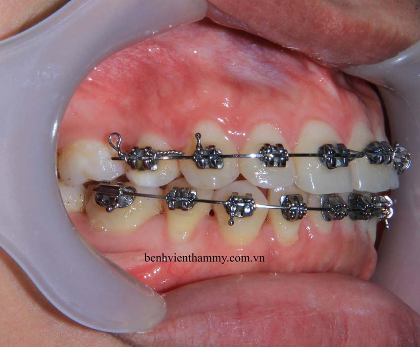 gia tri rang ho 7