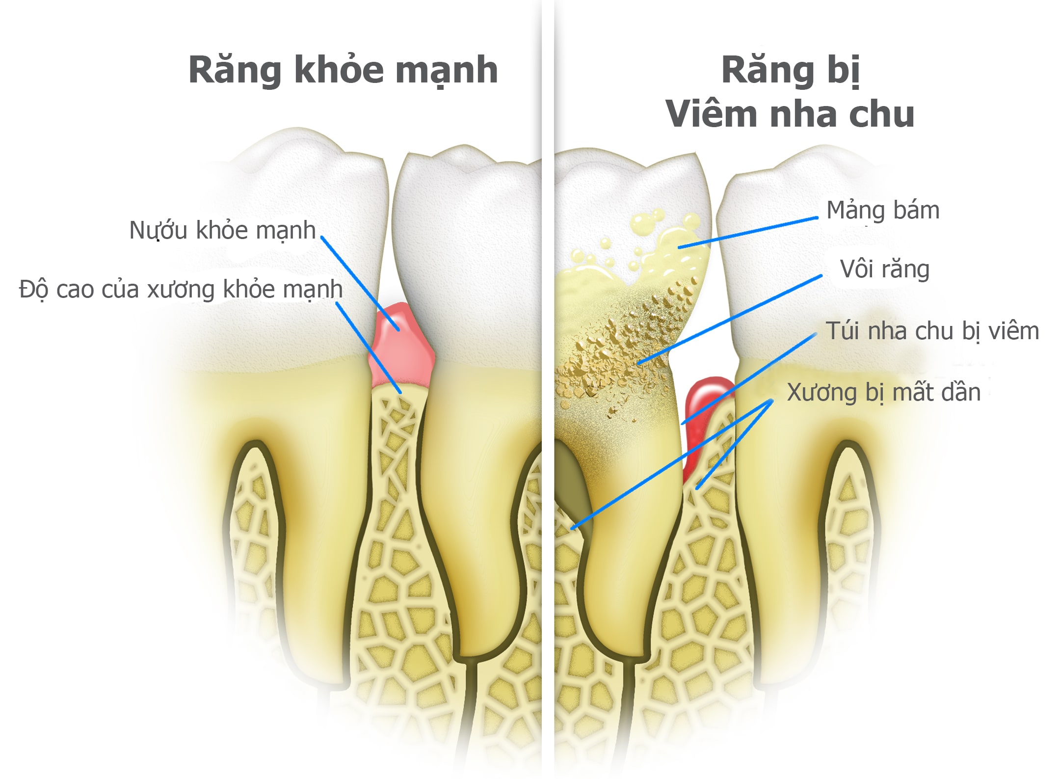 dieu tri nha chu viem nuou em ai voi airflow thuy si