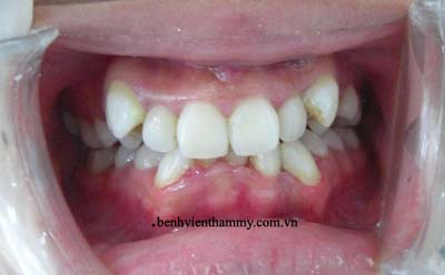 nieng-rang-khong-nho-a