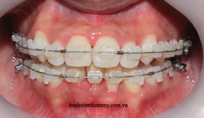 nieng-rang-khong-nho-rang-c